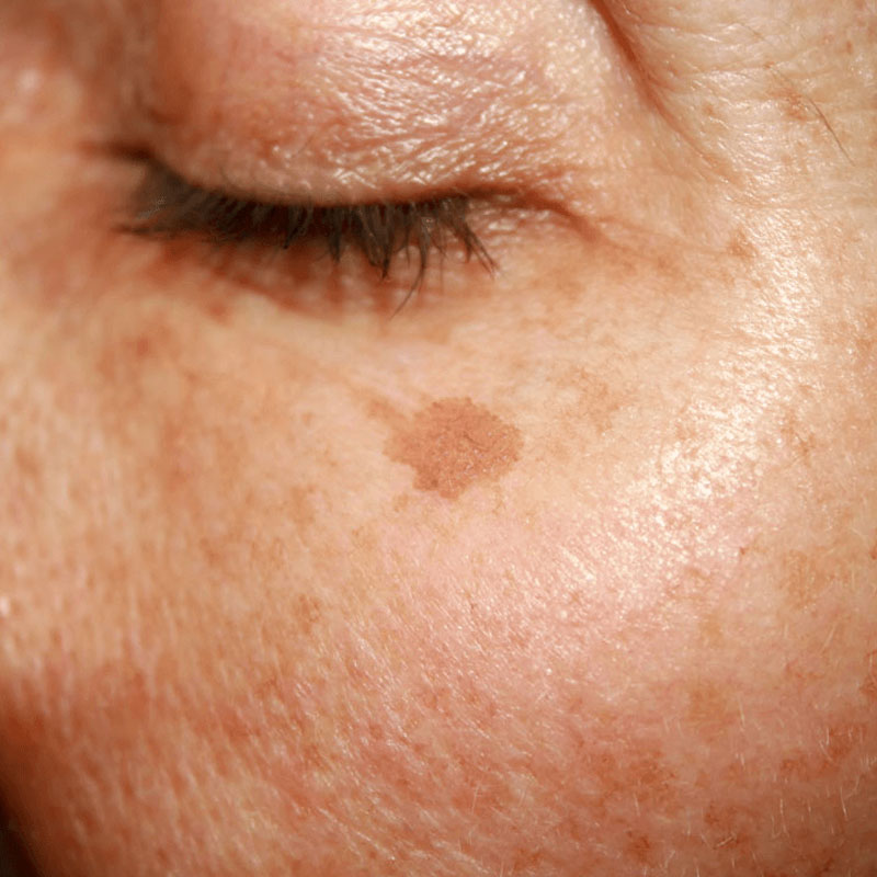 TRATAMIENTOS FACIALES Noemí Azor Centre Mèdic-Estètic a La Garriga