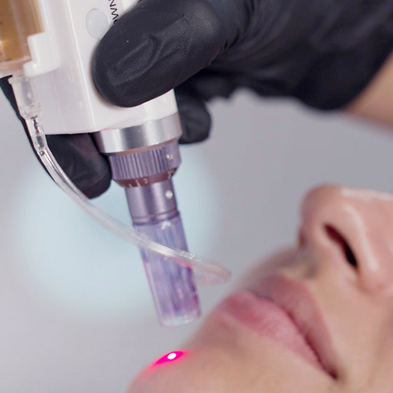 TRATAMIENTOS FACIALES Noemí Azor Centre Mèdic-Estètic a La Garriga