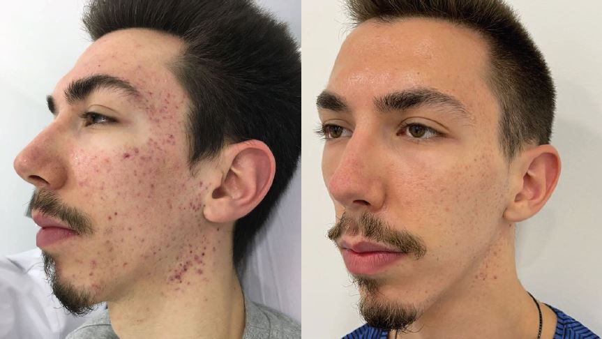 Neteja Vertical Laser Azul